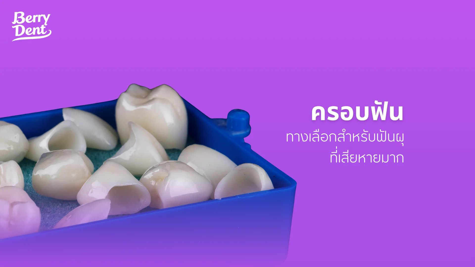 ครอบฟัน ทางเลือกสำหรับฟันผุที่เสียหายมาก 